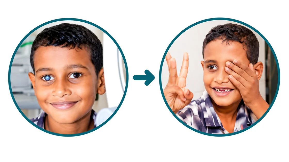 Hussein Ahmed before and after his eye surgery: a cloudy eye before, and smiling with his sight back after