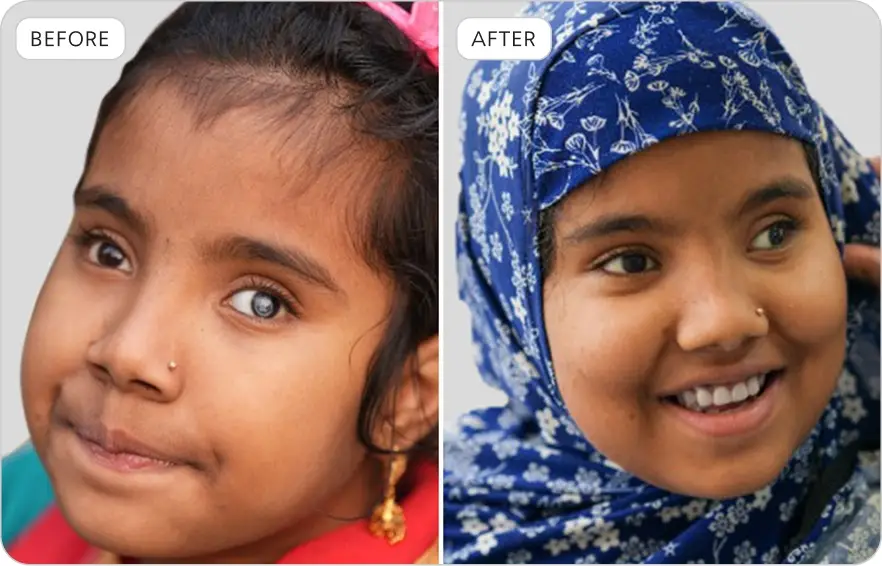 Albasar USA Joypurhat Eye Camp 2025 Before & After