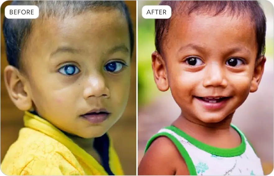 Albasar USA Rajshahi Eye Camp 2023 Before & After