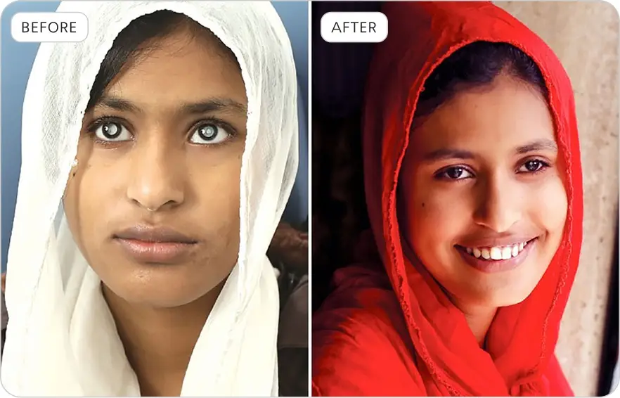 Albasar USA Rungpur Eye Camp Before & After